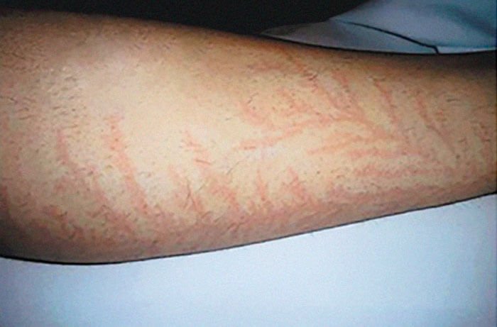 Lightning Strike Survivor: "Nobody Dies," Says NDE Expert