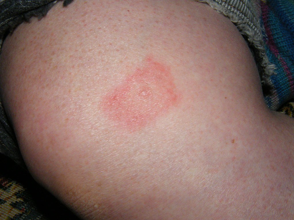 Lyme Disease Warning: Protect Yourself This Spring