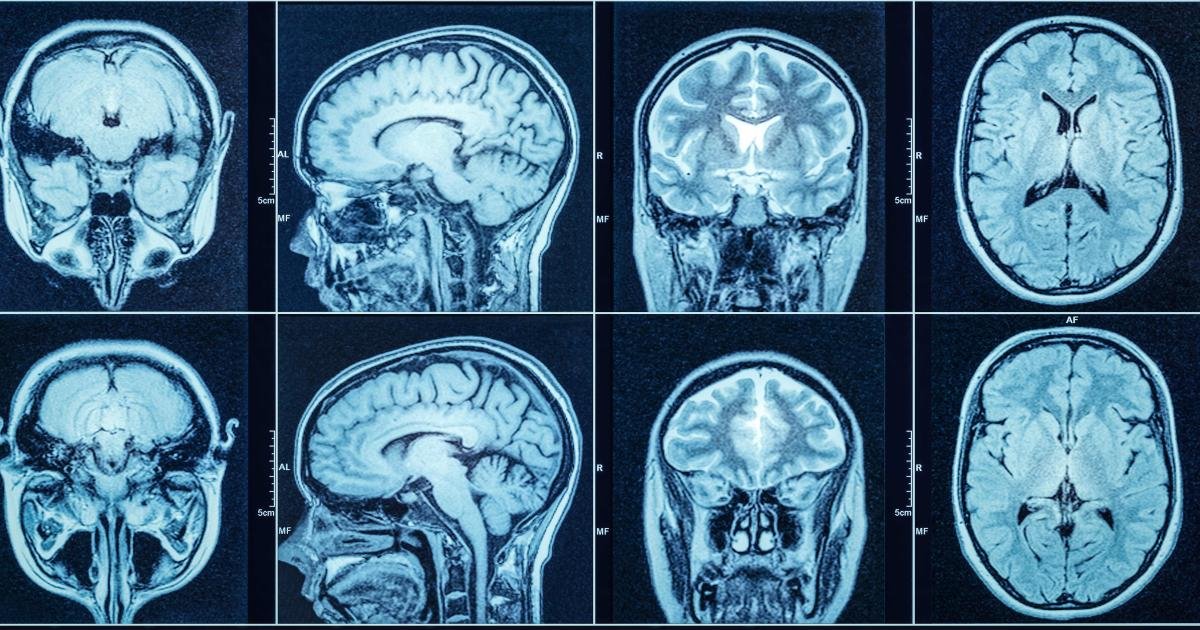 Obesity Linked to Severe Long COVID Neurological Symptoms